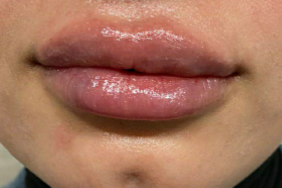 Lips After
