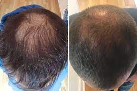 علاج تساقط الشعر من الجذور بتقنية ريجينيرا أكتيفا