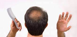 ما سبب تساقط الشعر عند الرجال العلاج بتقنية ريجينيرا أكتيفا