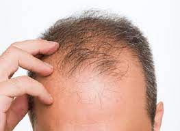 اسباب وقوع الشعر  العلاج بريجينيرا أكتيفا