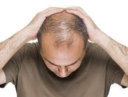ماهي اسباب تساقط الشعر عند الرجال بتقنية ريجينيرا أكتيفا Regenera Activa 