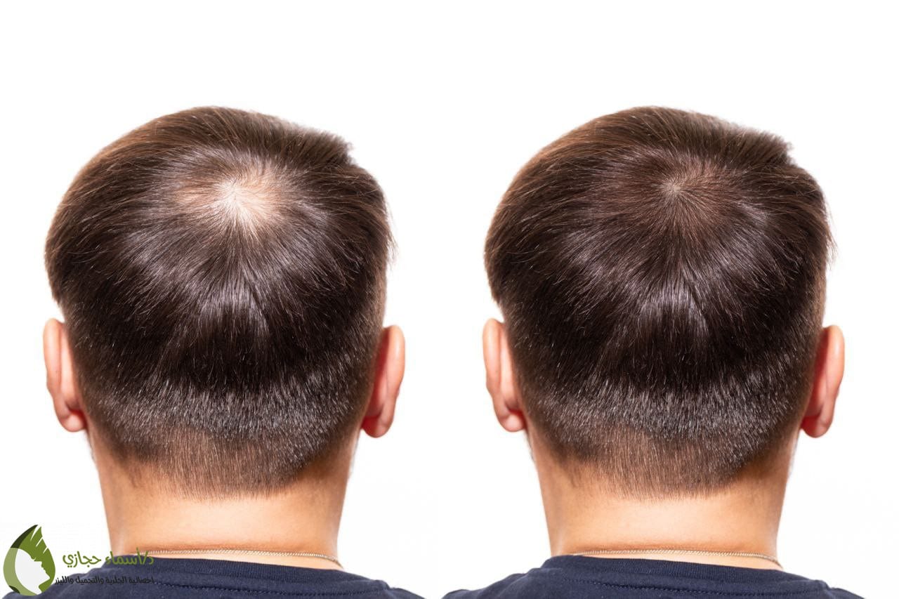 اماكن زراعة الشعر